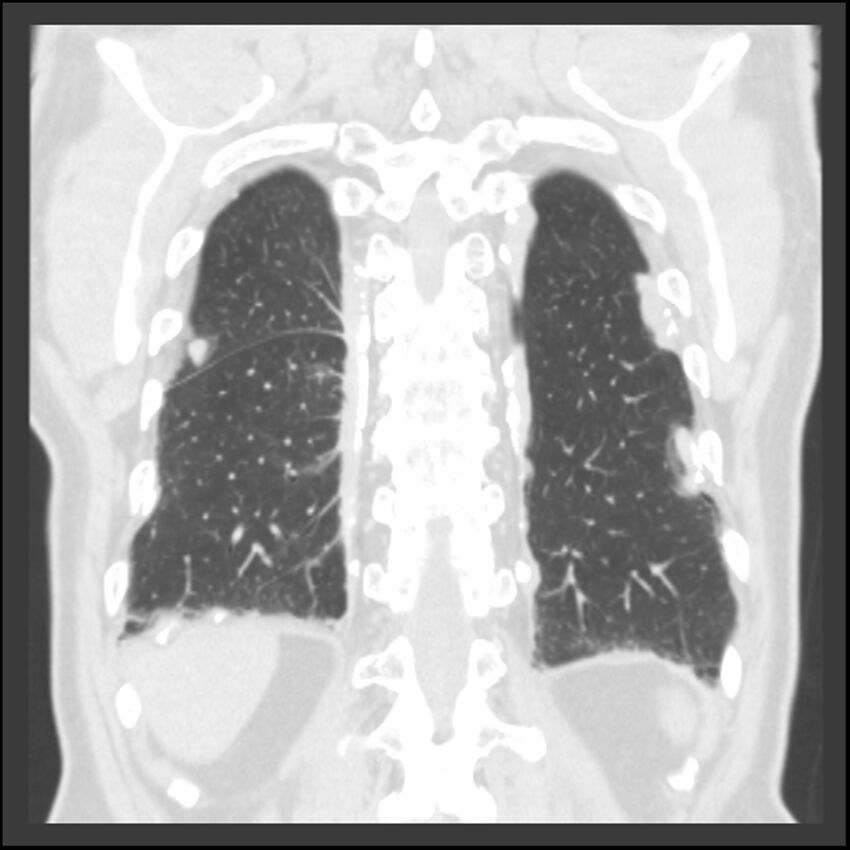 Asbestos-related pleural plaques (Radiopaedia 39069-41255 Coronal lung window 16).jpg