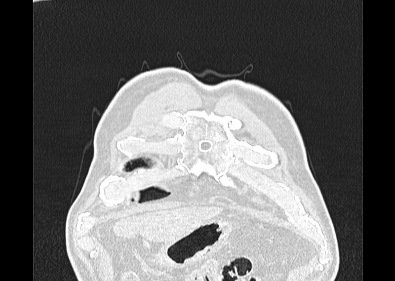 File:Asbestos pleural placques (Radiopaedia 57905-64872 Coronal lung window 6).jpg