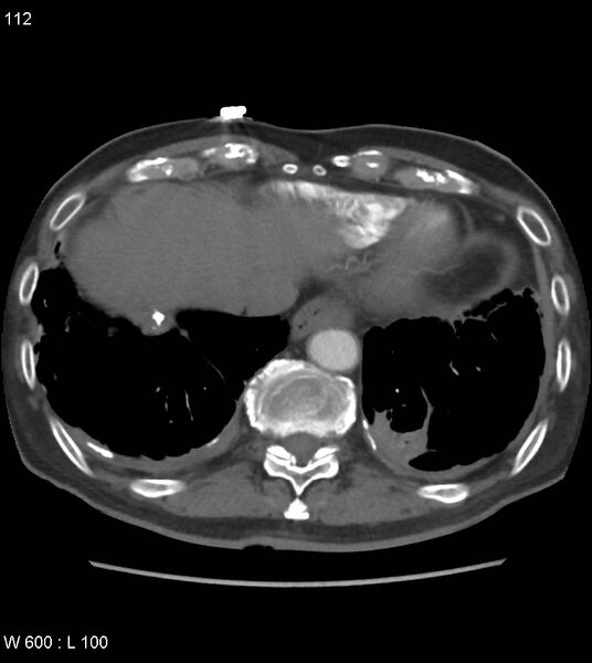 File:Asbestos related lung and pleural disease (Radiopaedia 14377-14301 D 48).jpg