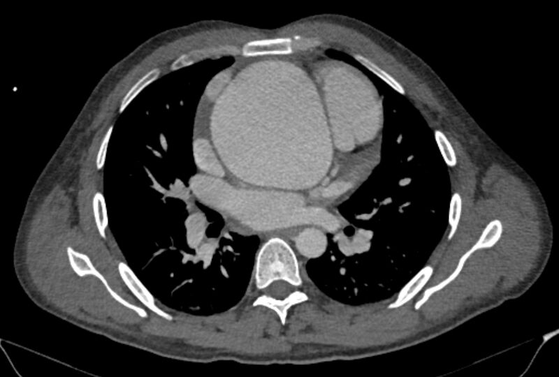 File:Ascending aortic aneurysm (Radiopaedia 86279-102297 C 30).jpg