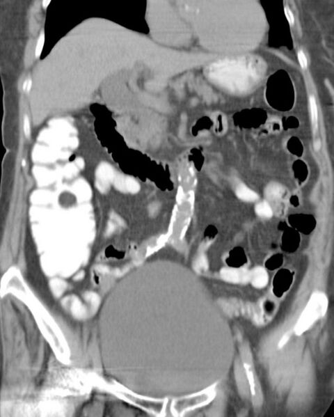 File:Ascending colon lipoma (Radiopaedia 2582-6276 Coronal liver window 1).jpg