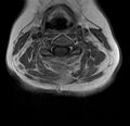 Astrocytoma - spinal cord (Radiopaedia 69769-79758 Axial T1 C+ 10).jpg