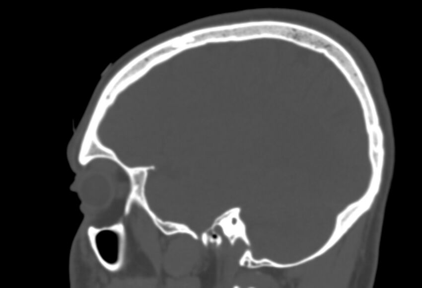 Asymptomatic occipital spur (Radiopaedia 87753-104201 Sagittal bone window 230).jpg