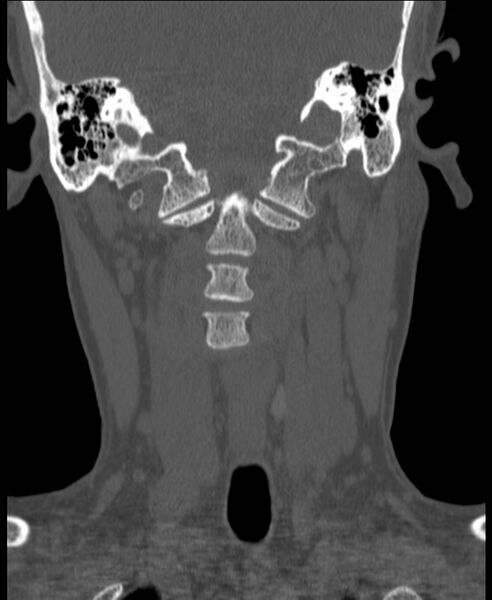 File:Atlanto-occipital assimilation with basilar invagination (Radiopaedia 70122-80188 Coronal bone window 73).jpg