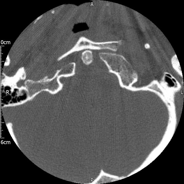 File:Atlas fracture with Currarino type A congenital defect (Radiopaedia 71747-82144 Axial bone window 15).jpg