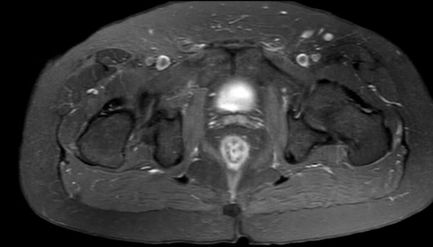 Atypical lipomatous tumor - thigh (Radiopaedia 68975-78734 Axial PD fat sat 89).jpg