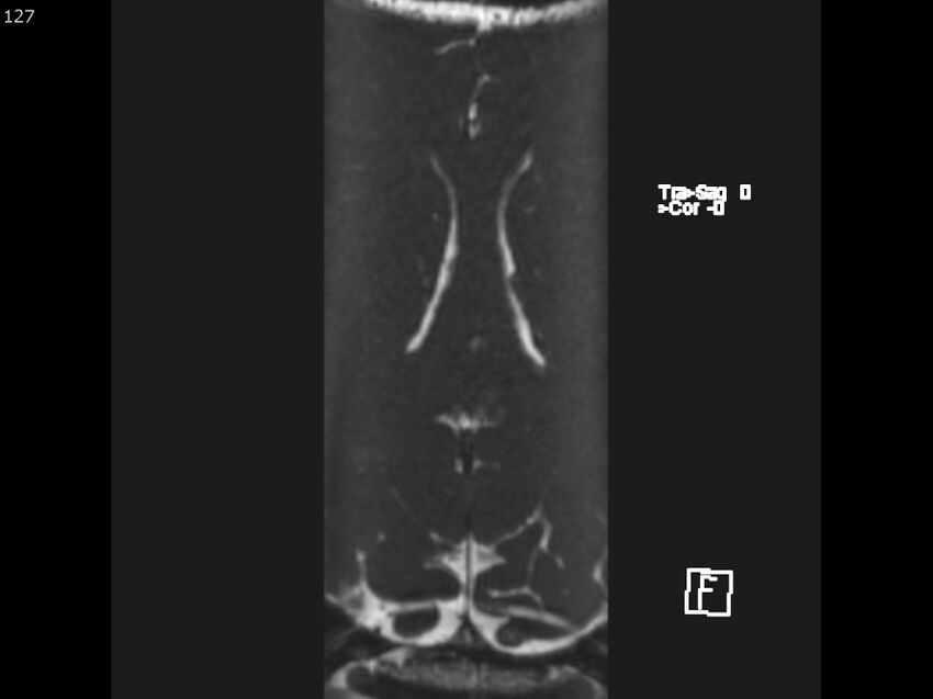 Atypical meningioma - intraosseous (Radiopaedia 64915-74572 Axial CISS 127).jpg
