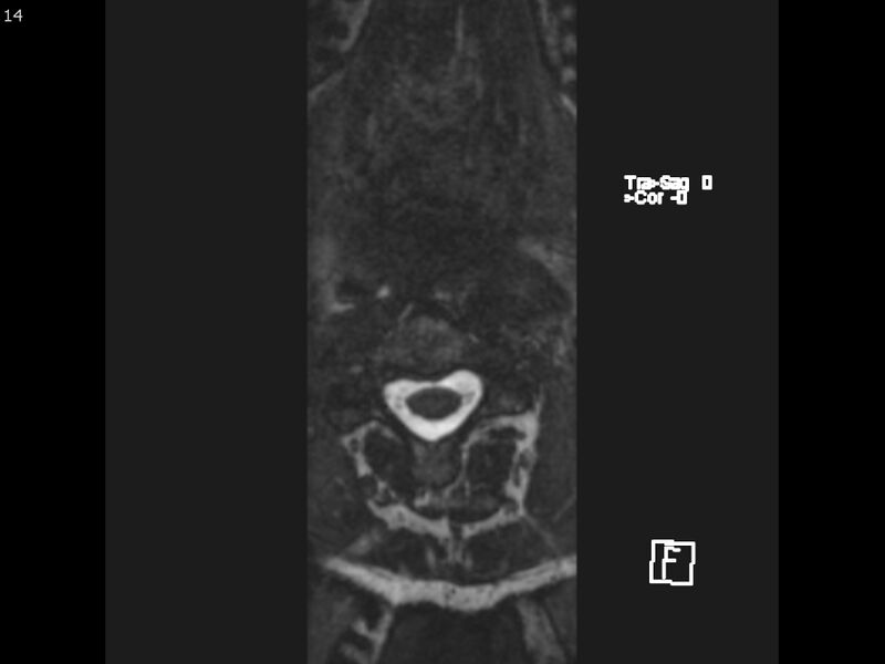 File:Atypical meningioma - intraosseous (Radiopaedia 64915-74572 Axial CISS 14).jpg