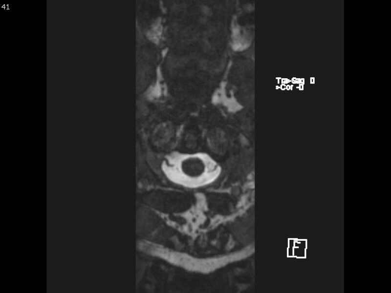 File:Atypical meningioma - intraosseous (Radiopaedia 64915-74572 Axial CISS 41).jpg