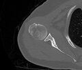 Avulsion fracture - greater tuberosity of humerus (Radiopaedia 71216-81514 Axial bone window 36).jpg