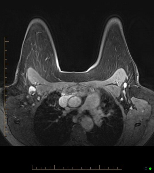 File:Axillary lymphadenopathy on breast MRI- yellow fever vaccination induced (Radiopaedia 19454-19483 Axial T1 C+ fat sat 27).jpg
