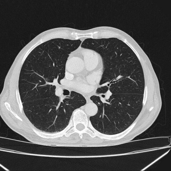 File:Azygos lobe (Radiopaedia 38259-40275 Axial lung window 42).jpg
