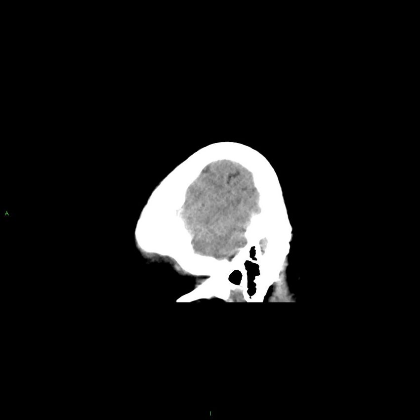 Basal ganglia hemorrhage (Radiopaedia 58349-65472 C 47).jpg
