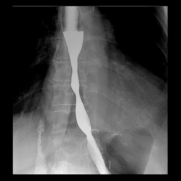 File:Benign esophageal stricture - post reflux (Radiopaedia 75592-86878 G 1).jpg