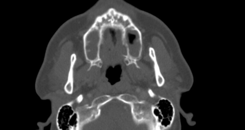 File:Benign mixed salivary tumor of the parotid gland (Radiopaedia 35261-36792 Axial bone window 13).jpg