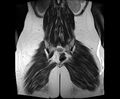 Bicornuate bicollis uterus (Radiopaedia 61626-69616 Coronal T2 31).jpg