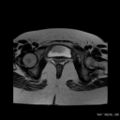 Bicornuate uterus- on MRI (Radiopaedia 49206-54297 Axial T2 14).jpg