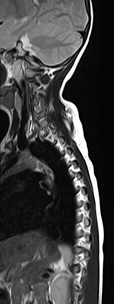 File:Bilateral Sprengel deformity with Klippel-Feil syndrome (Radiopaedia 66395-75650 Sagittal T2 11).jpg