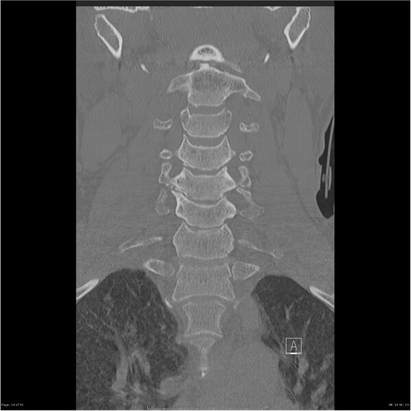 File:Bilateral cervical ribs (Radiopaedia 25868-26017 Coronal bone window 14).jpg