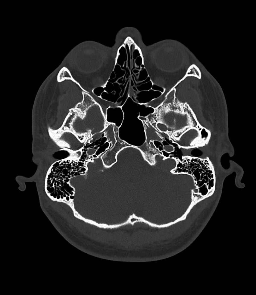 Bilateral medial canal fibrosis (Radiopaedia 85598-101344 Axial bone window 18).jpg