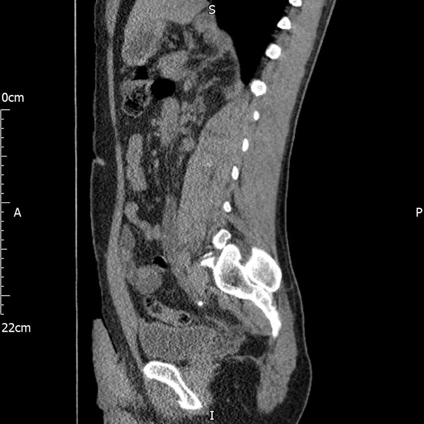 Bilateral medullary nephrocalcinosis with ureteric calculi (Radiopaedia 71269-81569 C 50).jpg