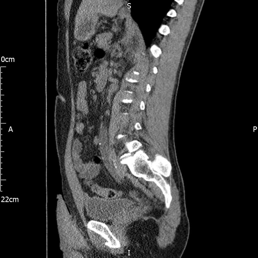 Bilateral medullary nephrocalcinosis with ureteric calculi (Radiopaedia 71269-81569 C 51).jpg