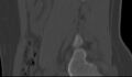 Bilateral pars defect (Radiopaedia 26691-26846 Sagittal bone window 13).jpg