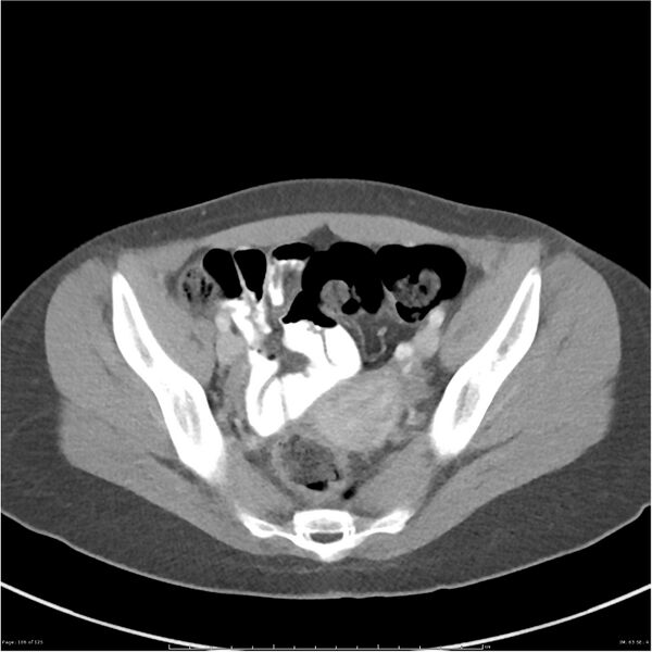 File:Bilateral ureteritis and cystitis (Radiopaedia 25340-25594 A 63).jpg