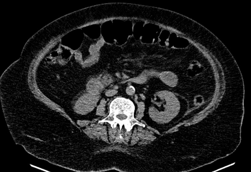 File:Biliary pancreatitis (Radiopaedia 72289-82823 Axial non-contrast 134).jpg