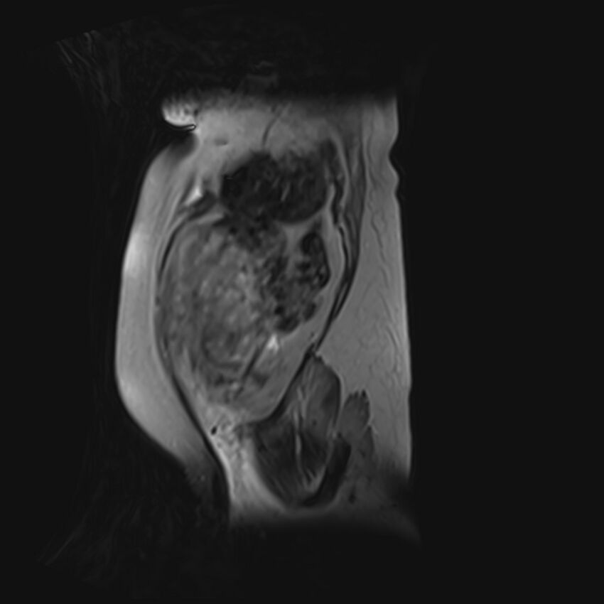 Bilobed placenta accreta (Radiopaedia 69648-79591 G 55).jpg