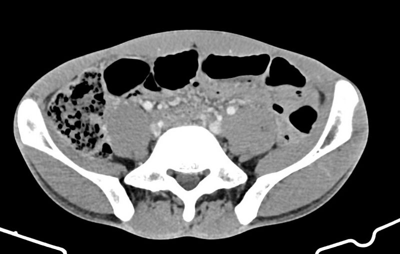 File:Blunt injury to the small bowel (Radiopaedia 74953-85987 A 133).jpg