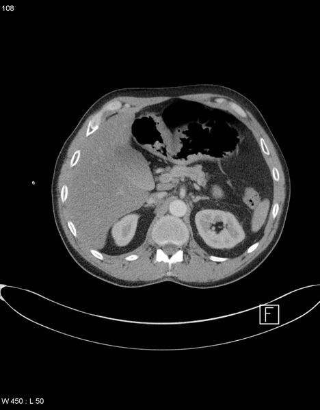 File:Boerhaave syndrome with tension pneumothorax (Radiopaedia 56794-63605 A 53).jpg
