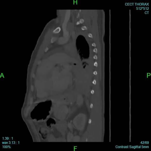 File:Bone metastases from lung carcinoma (Radiopaedia 54703-60937 Sagittal bone window 42).jpg