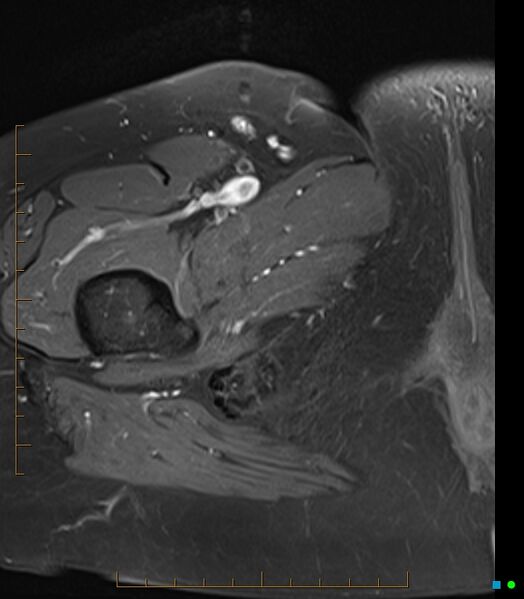 File:Bone metastasis - breast cancer (Radiopaedia 16667-16374 Axial T1 C+ fat sat 1).jpg