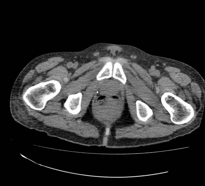 File:Bowel lymphoma complicated by bleeding after therapy (Radiopaedia 55601-62110 Axial non-contrast 83).jpg