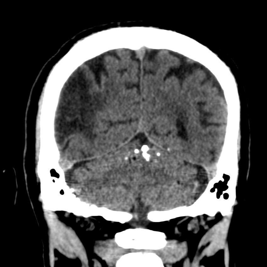 Brain Pantopaque remnants (Radiopaedia 78403-91048 Coronal non-contrast 53).jpg