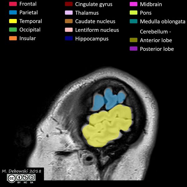 File:Brain lobes - annotated MRI (Radiopaedia 61691-69700 Sagittal 77).JPG
