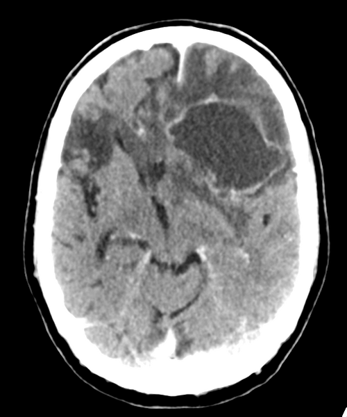 File:Brain metastasis (lung cancer) (Radiopaedia 48289-53177 Axial C+ 13).png