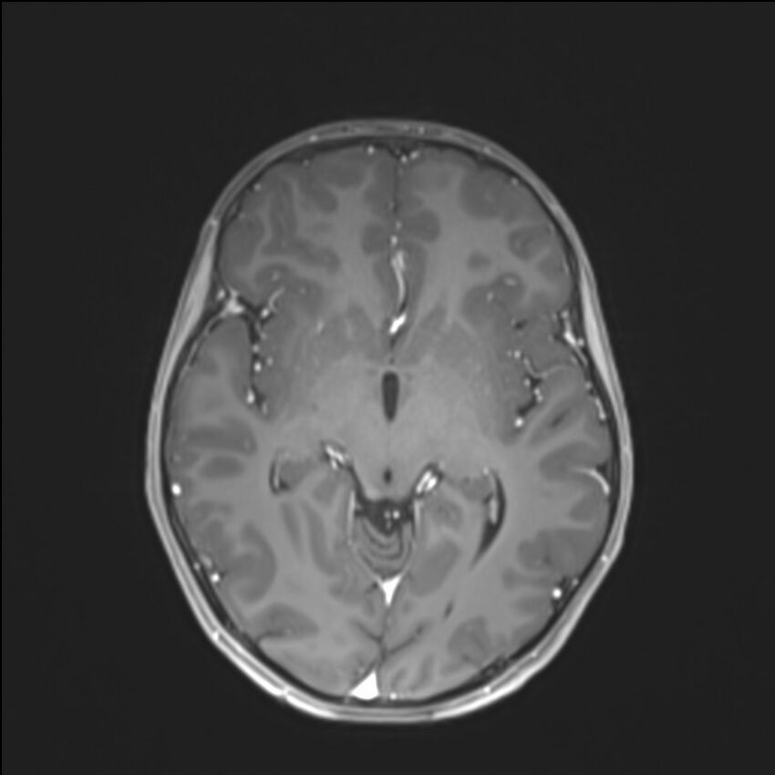 Brainstem glioma (Radiopaedia 70548-80674 Axial T1 C+ 77).jpg