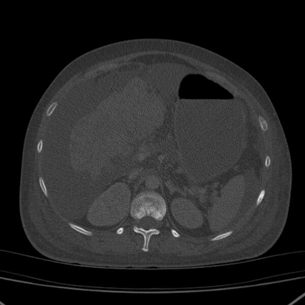 File:Breast cancer metastases - hepatic and skeletal (Radiopaedia 34201-35461 Axial bone window 45).jpg
