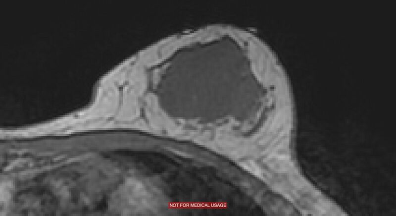 File:Breast lymphoma (MRI) (Radiopaedia 34999-36498 Axial T1 11).jpg