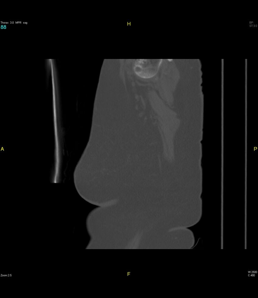 Breast primary with lung and bone metastases (Radiopaedia 40620-43228 Sagittal bone window 88).jpg