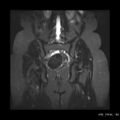Broad ligament fibroid (Radiopaedia 49135-54241 Coronal STIR 18).jpg
