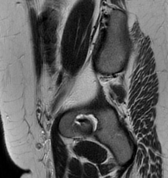 File:Broad ligament leiomyoma (Radiopaedia 81634-95516 Sagittal T2 26).jpg