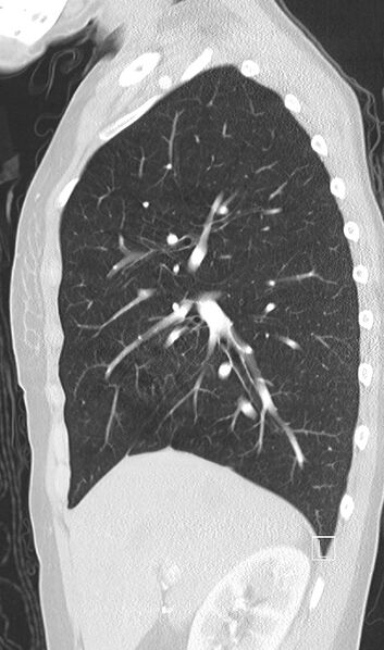 File:Bronchial atresia (Radiopaedia 73677-84470 Sagittal lung window 18).jpg