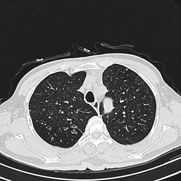 File:Bronchiectasis (Radiopaedia 22061-22059 lung window 7).jpg