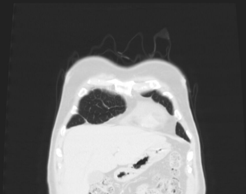 Bronchogenic carcinoma with lymphangitic spread (Radiopaedia 29002-29357 Coronal lung window 2).jpg