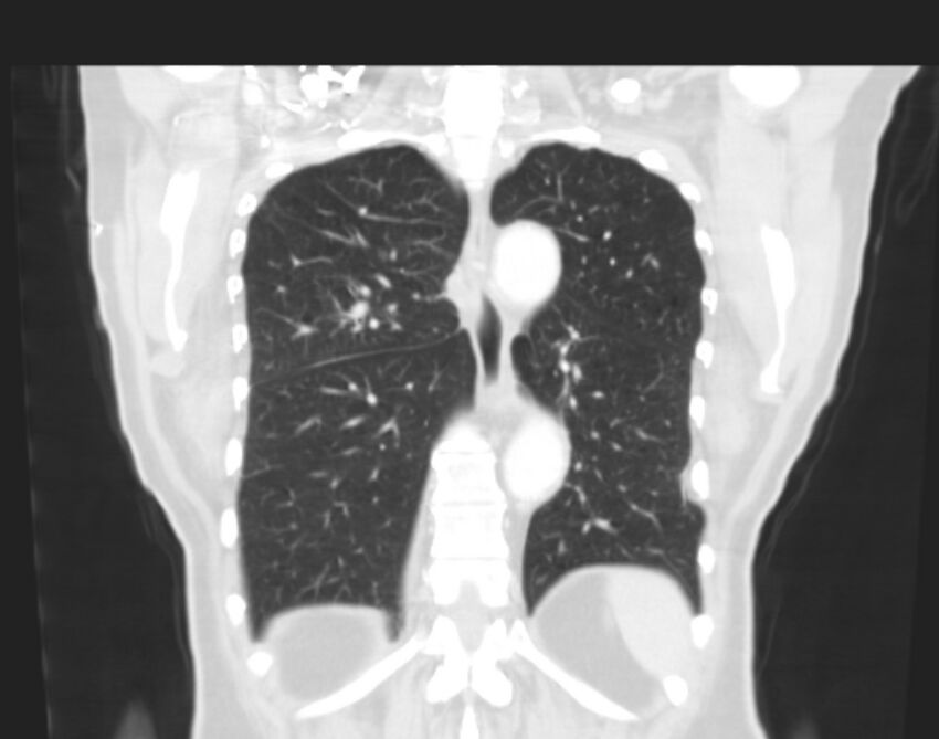 Bronchogenic carcinoma with lymphangitic spread (Radiopaedia 29002-29357 Coronal lung window 52).jpg