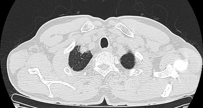 File:Bronchogenic carcinoma with superior vena cava syndrome (Radiopaedia 36497-38054 Axial lung window 6).jpg