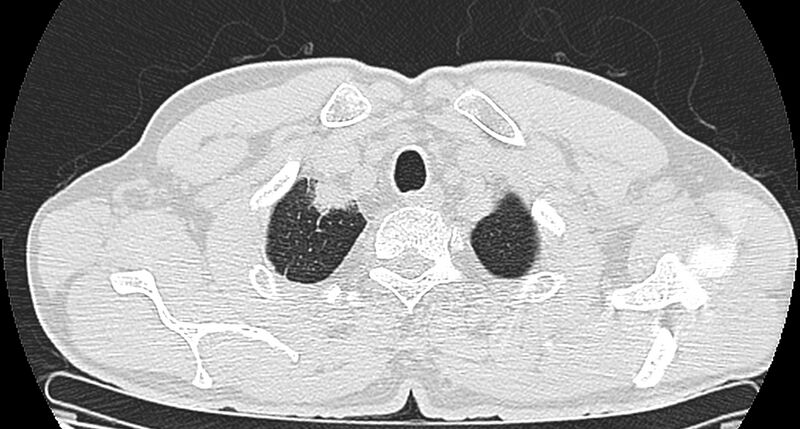 File:Bronchogenic carcinoma with superior vena cava syndrome (Radiopaedia 36497-38054 Axial lung window 7).jpg